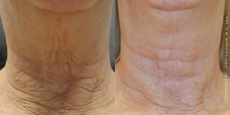 Before and After photo of Genius RF treatment at The Hughes Center in Cherry Hill NJ