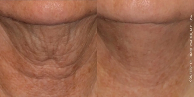 Before and After photo of Genius RF treatment at The Hughes Center in Cherry Hill NJ