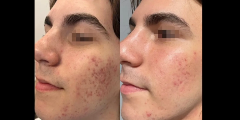 Before and After photo of an Opus Plasma patient from The Hughes Center in Cherry Hill NJ