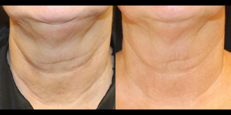 Before and After photo of an Opus Plasma patient from The Hughes Center in Cherry Hill NJ