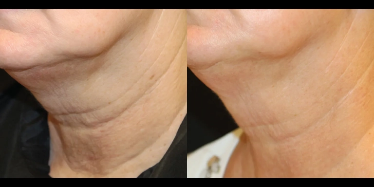 Before and After photo of an Opus Plasma patient from The Hughes Center in Cherry Hill NJ