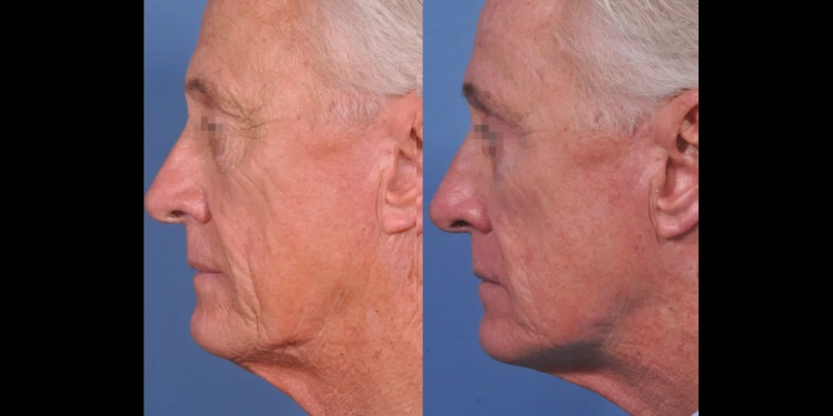 Before and After photo of an Opus Plasma patient from The Hughes Center in Cherry Hill NJ