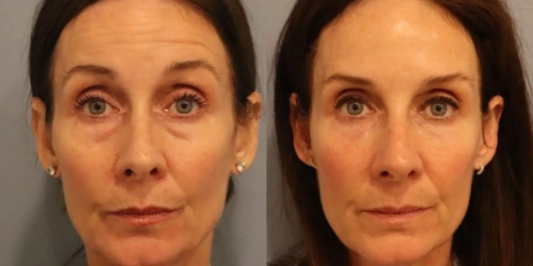 Before and after photo of Botox and Dysport at The Hughes Center medspa in Cherry Hill NJ