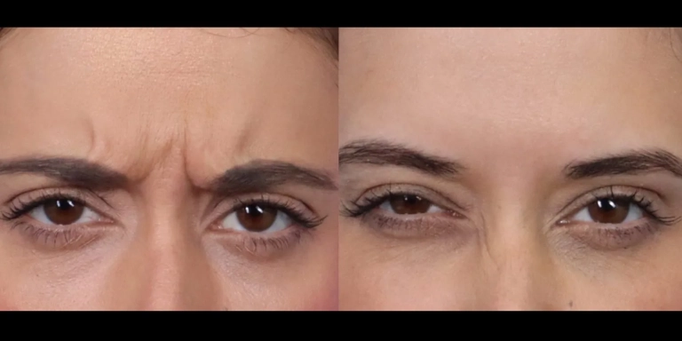 Before and after photo of Botox and Dysport at The Hughes Center medspa in Cherry Hill NJ