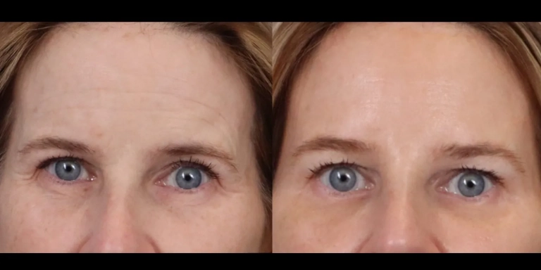 Before and after photo of Botox and Dysport at The Hughes Center medspa in Cherry Hill NJ