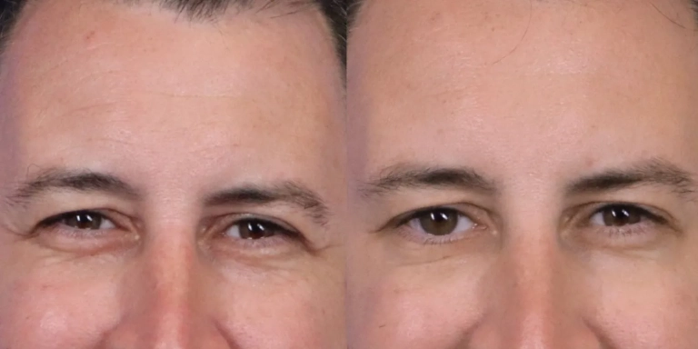 Before and after photo of Botox and Dysport at The Hughes Center medspa in Cherry Hill NJ