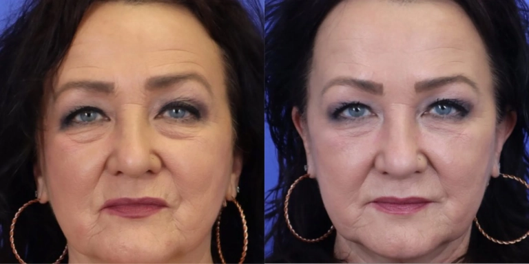 Before and after photo of Botox and Dysport at The Hughes Center medspa in Cherry Hill NJ