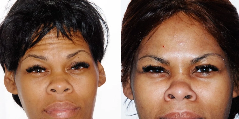 Before and after photo of Botox and Dysport at The Hughes Center medspa in Cherry Hill NJ