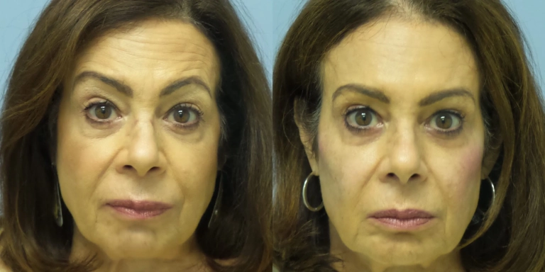 Before and after photo of Botox and Dysport at The Hughes Center medspa in Cherry Hill NJ