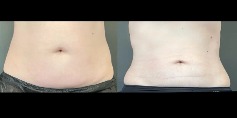 Case 1125 Coolsculpting