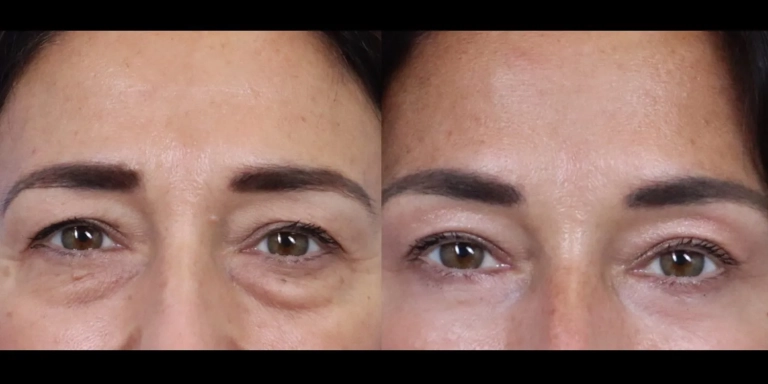 Before and after photo of Eyelid cosmetic surgery at The Hughes Center medspa in Cherry Hill NJ