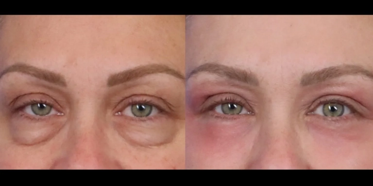 Before and after photo of Eyelid cosmetic surgery at The Hughes Center medspa in Cherry Hill NJ