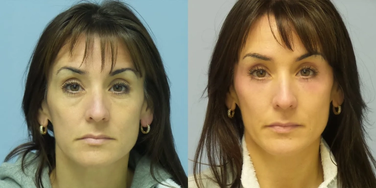 Before and after photo of Eyelid cosmetic surgery at The Hughes Center medspa in Cherry Hill NJ