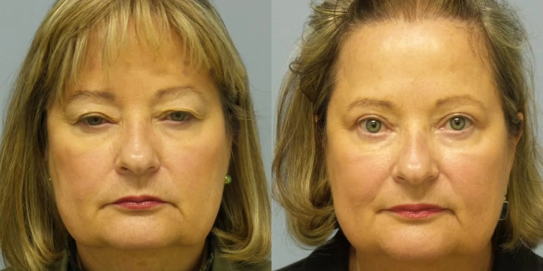 Before and after photo of Eyelid cosmetic surgery at The Hughes Center medspa in Cherry Hill NJ