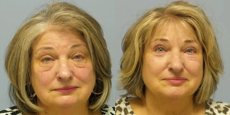Before and after photo of Eyelid cosmetic surgery at The Hughes Center medspa in Cherry Hill NJ