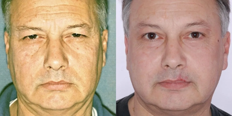 Before and after photo of fat transfer cosmetic procedure at The Hughes Center medspa in Cherry Hill NJ