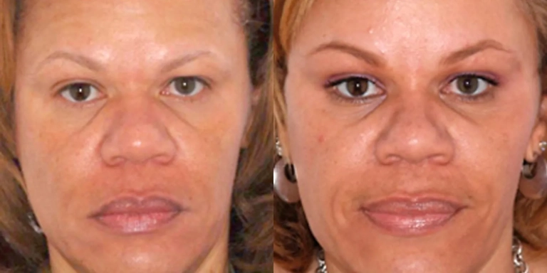 Before and after photo of fat transfer cosmetic procedure at The Hughes Center medspa in Cherry Hill NJ