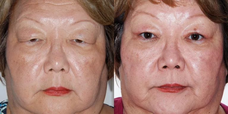 Before and after photo of Eyelid cosmetic surgery at The Hughes Center medspa in Cherry Hill NJ