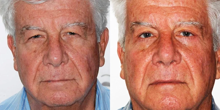 Before and after photo of Eyelid cosmetic surgery at The Hughes Center medspa in Cherry Hill NJ