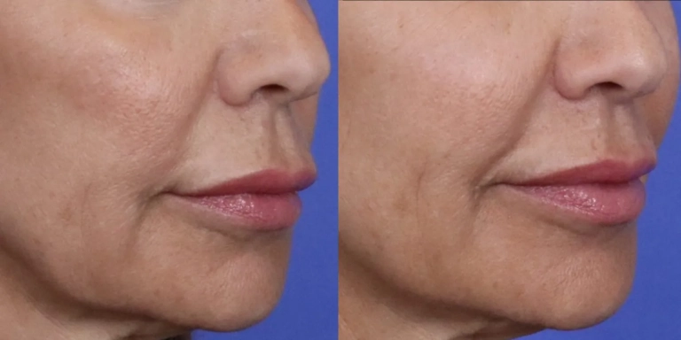 Before and after photo of facial fillers at The Hughes Center medspa in Cherry Hill NJ