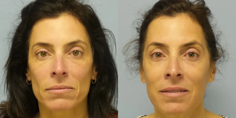 Before and after photo of facial fillers at The Hughes Center medspa in Cherry Hill NJ