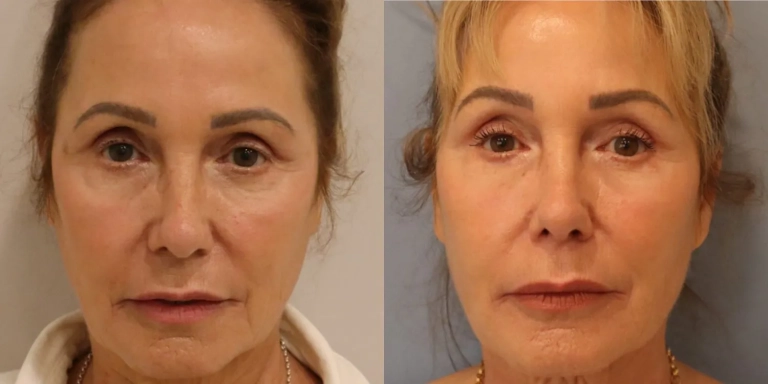 Before and after photo of facial fillers at The Hughes Center medspa in Cherry Hill NJ