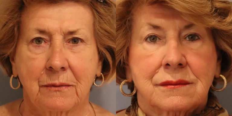 Before and after photo of facial fillers at The Hughes Center medspa in Cherry Hill NJ