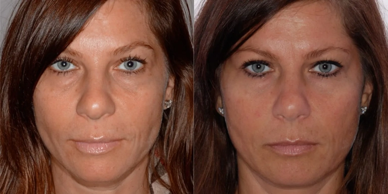 Before and after photo of facial fillers at The Hughes Center medspa in Cherry Hill NJ