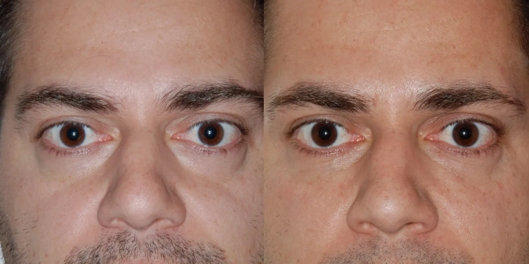 Before and after photo of facial fillers at The Hughes Center medspa in Cherry Hill NJ