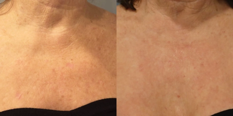 Before & After photo for Intense Pulsed Light (IPL) at The Hughes Center in Cherry Hill NJ