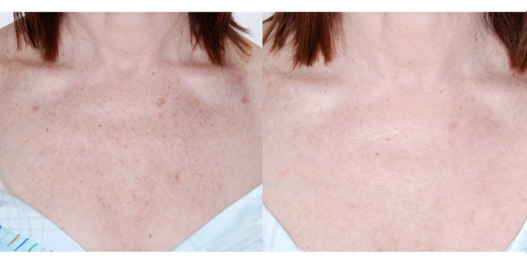 Before & After photo for Intense Pulsed Light (IPL) at The Hughes Center in Cherry Hill NJ