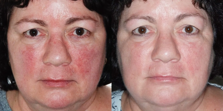 Before & After photo for Intense Pulsed Light (IPL) at The Hughes Center in Cherry Hill NJ