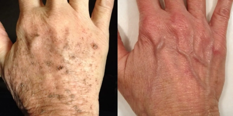 Before & After photo for Intense Pulsed Light (IPL) at The Hughes Center in Cherry Hill NJ