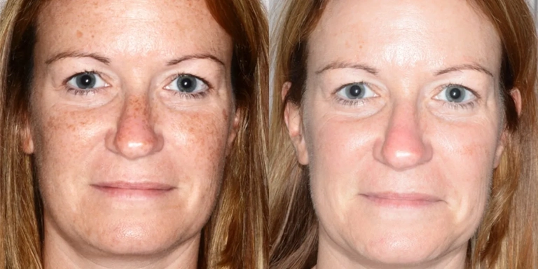 Before & After photo for Intense Pulsed Light (IPL) at The Hughes Center in Cherry Hill NJ