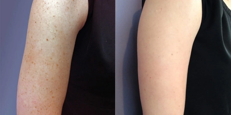 Before & After photo for Intense Pulsed Light (IPL) at The Hughes Center in Cherry Hill NJ