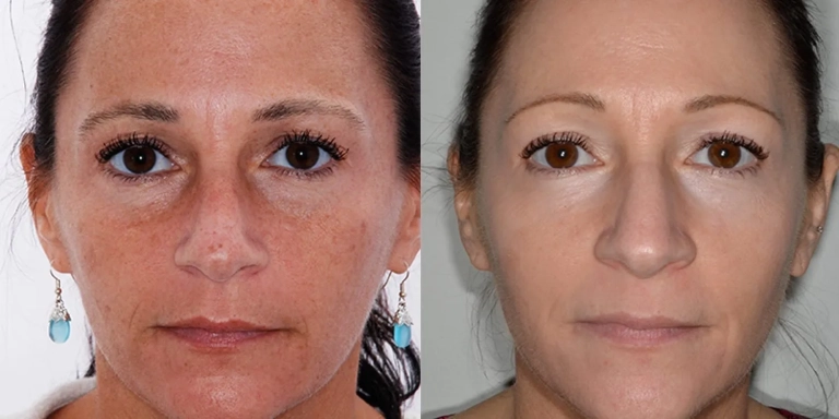 Before & After photo for Intense Pulsed Light (IPL) at The Hughes Center in Cherry Hill NJ