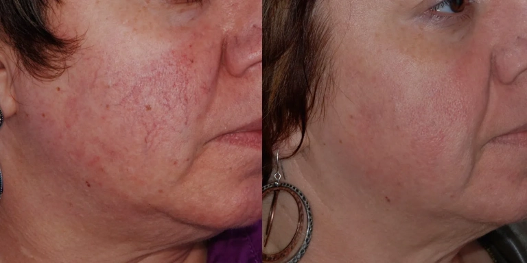 Before & After photo for Intense Pulsed Light (IPL) at The Hughes Center in Cherry Hill NJ