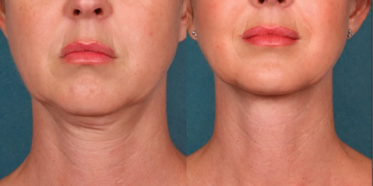 Kybella before & after photo chin close up from The Hughes Center in Cherry Hill NJ
