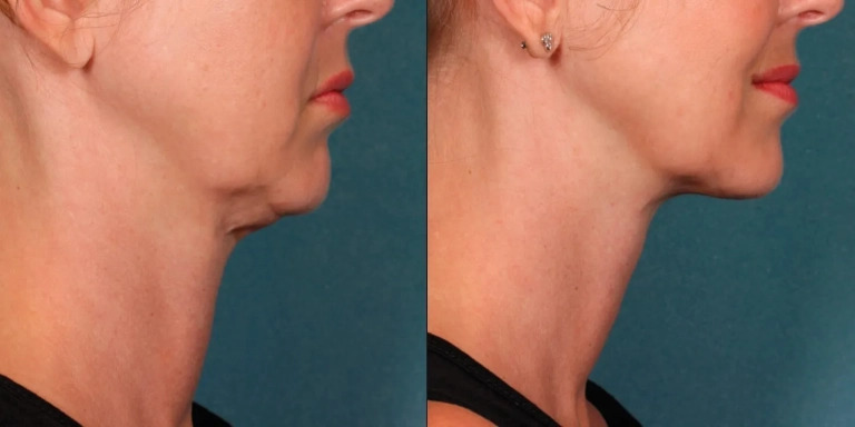 Kybella before & after photo from The Hughes Center in Cherry Hill NJ