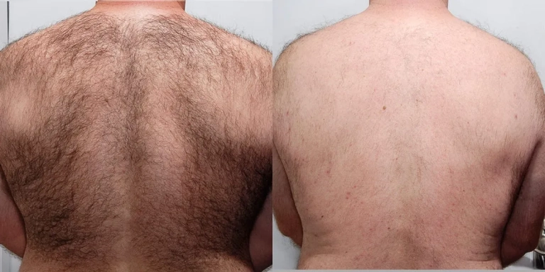 Before & After photo for Laser Hair Removal at The Hughes Center in Cherry Hill NJ