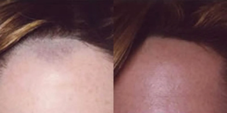 Before & After photo for Laser Hair Removal at The Hughes Center in Cherry Hill NJ