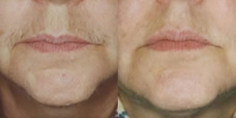 Before & After photo for Laser Hair Removal at The Hughes Center in Cherry Hill NJ