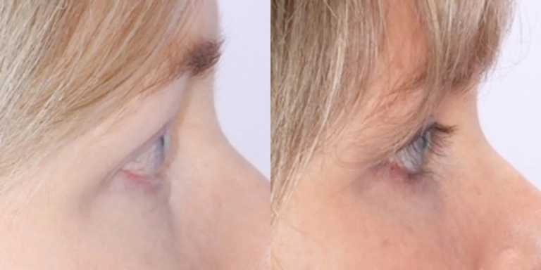 Before and after photo of Latisse at The Hughes Center medspa in Cherry Hill NJ