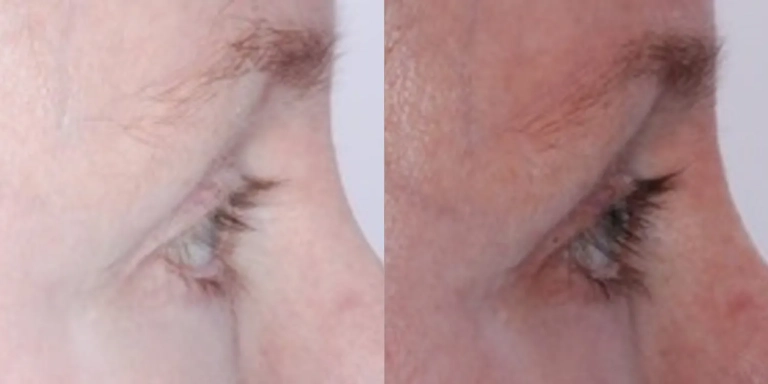Before and after photo of Latisse at The Hughes Center medspa in Cherry Hill NJ