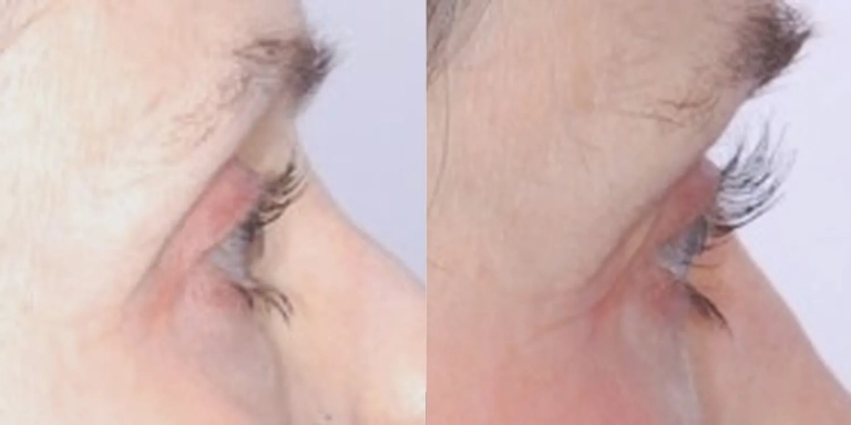 Before and after photo of Latisse at The Hughes Center medspa in Cherry Hill NJ