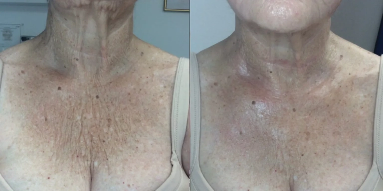 Before & After photo for PRX Derm Perfexion at The Hughes Center in Cherry Hill NJ