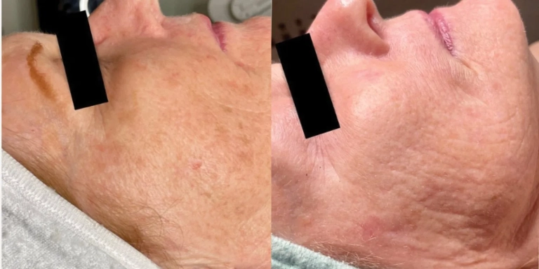 Before & After photo for PRX Derm Perfexion at The Hughes Center in Cherry Hill NJ