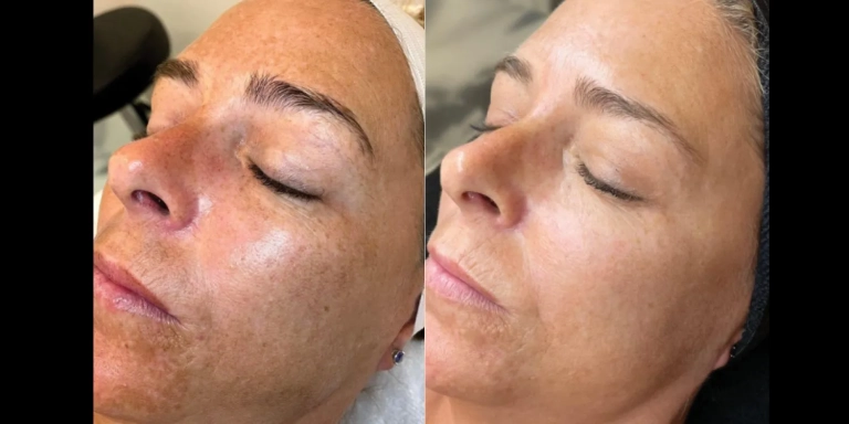 Before & After photo for PRX Derm Perfexion at The Hughes Center in Cherry Hill NJ