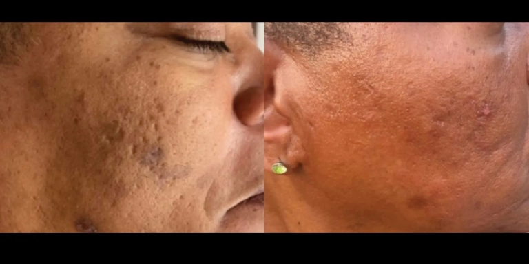 Before & After photo for PRX Derm Perfexion at The Hughes Center in Cherry Hill NJ